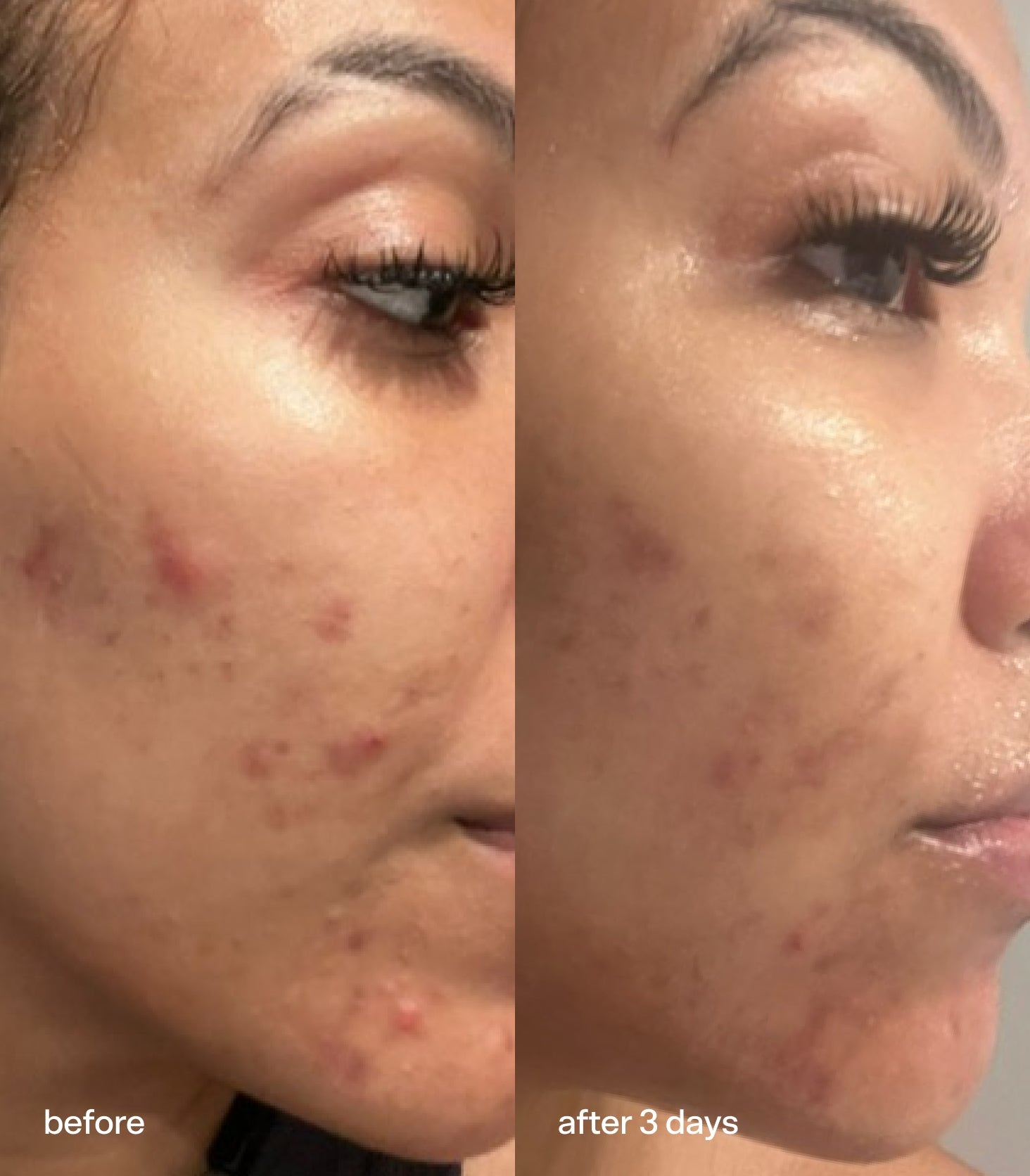 Knock Out Acne Spot Treatment by Bubble Skincare