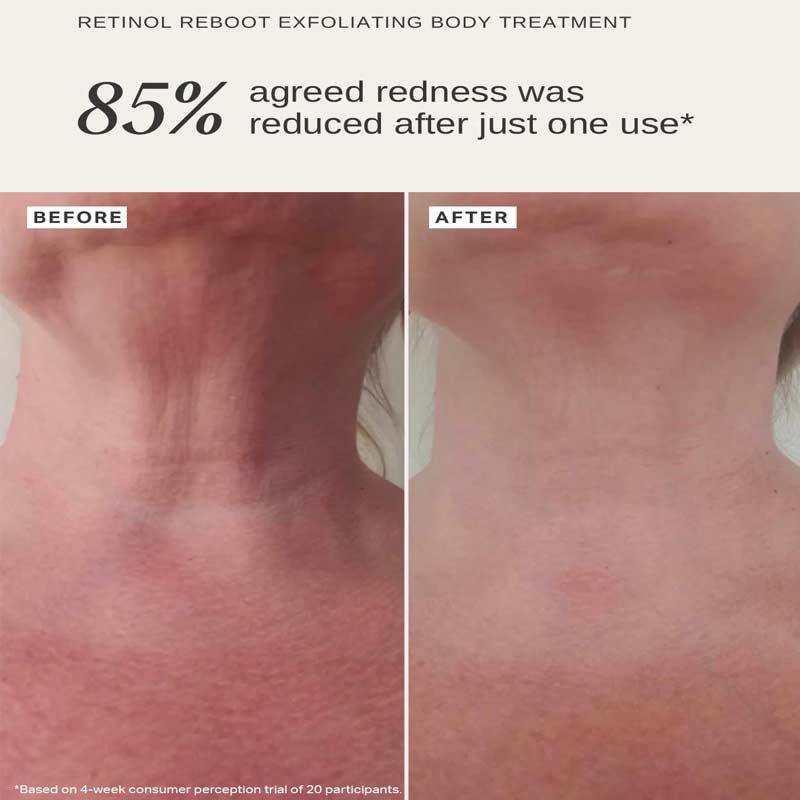 Retinol Reboot Exfoliating Body Treatment 1% Encapsulated Retinol by Alpha-H