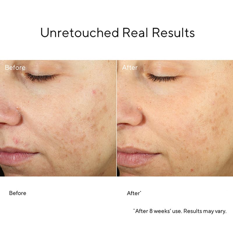 Blemish Control InvisiScar Resurfacing Treatment