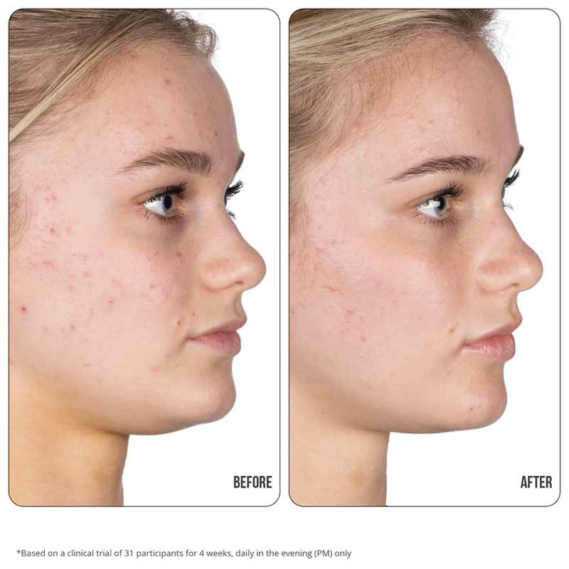 Retinol Fix Blemish Gel Treatment 10%