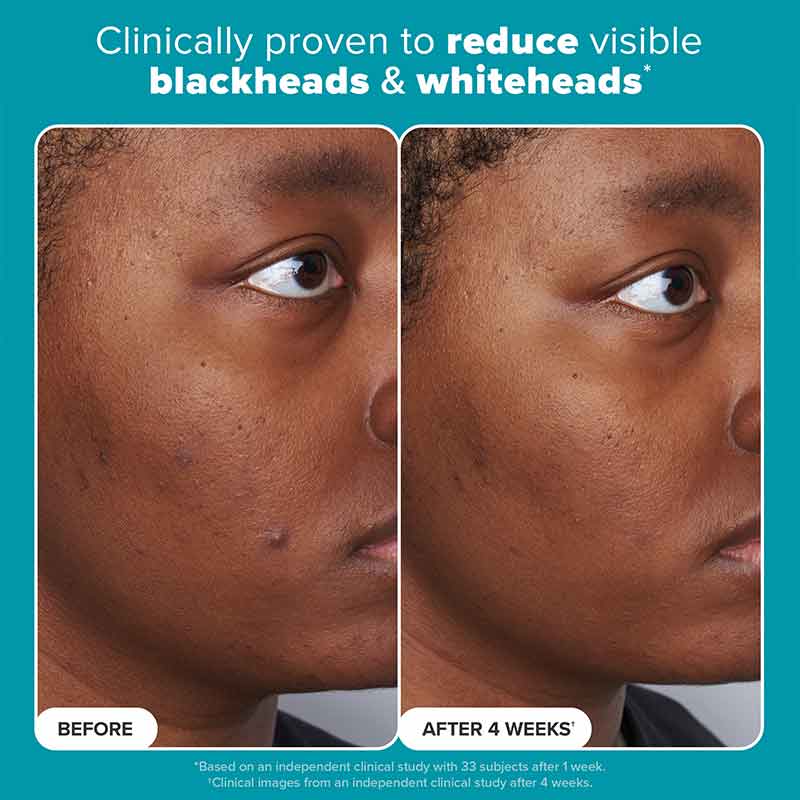 Skin Perfecting 2% BHA Exfoliating Toner + Boost 10% Azelaic Acid