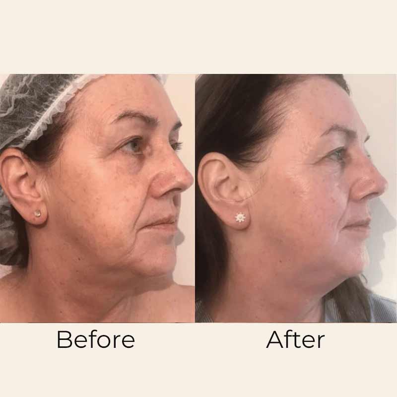 Mask Exfoliator 2N1 Formula by Skin Formulas