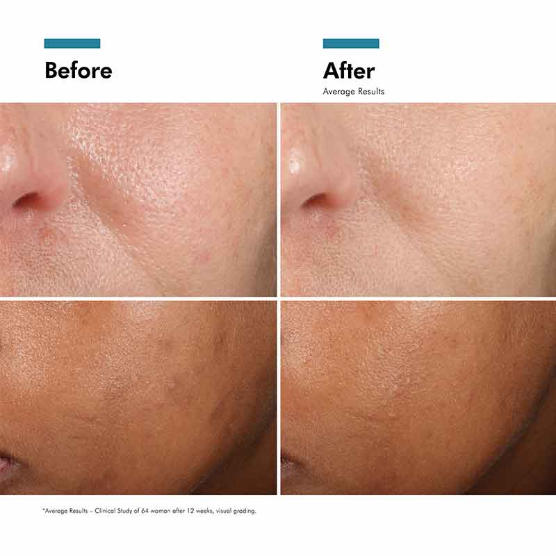 Phloretin CF Serum For Discolouration 30ml